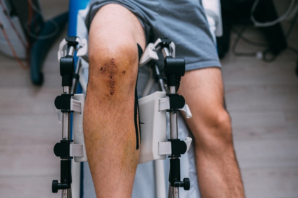Pasivna mobilizacija kolena nakon opercije prednjeg ukrštenog ligamenta