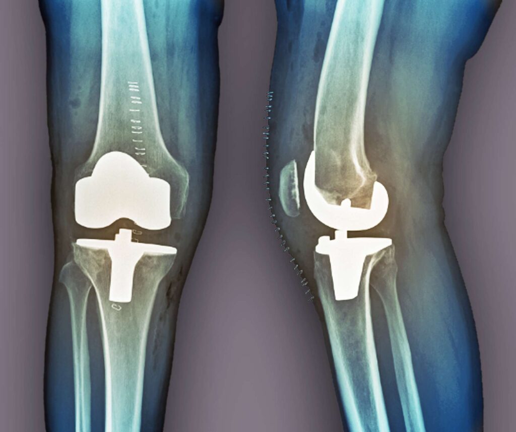 proteza kolena